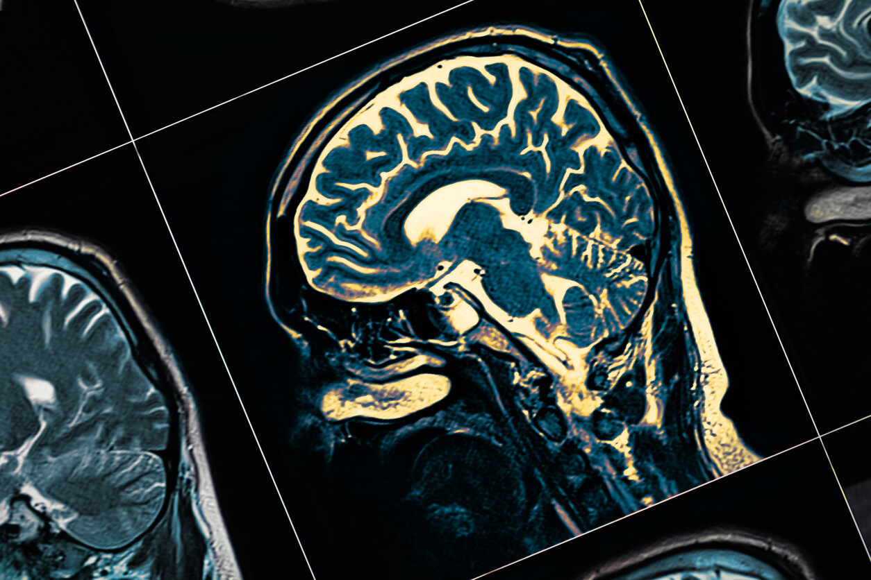 Rebaixamento cognitivo e seus efeitos